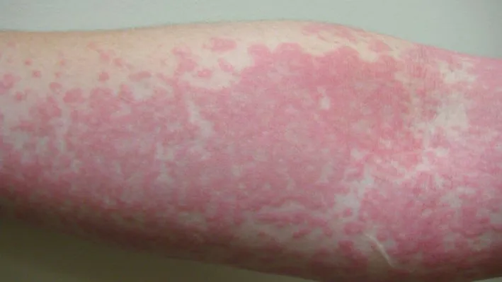 skynews-hives-coronavirus-rash_5040159.jpg