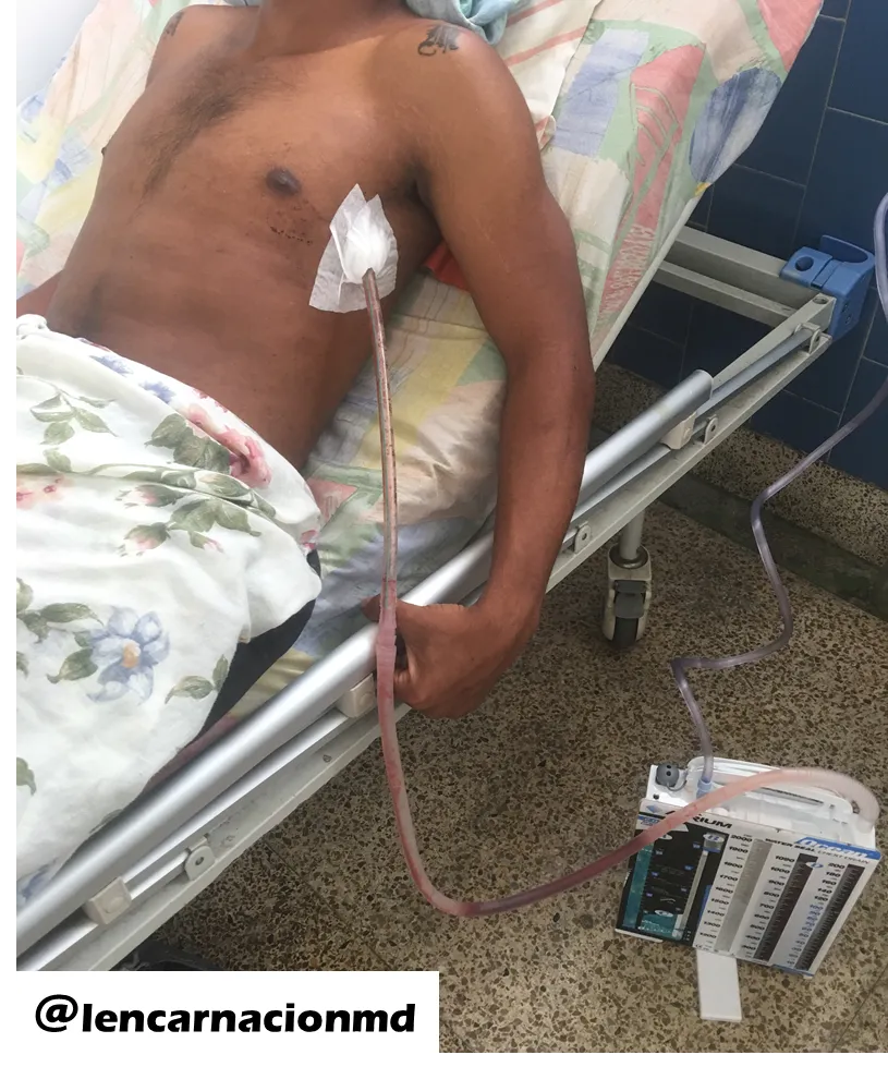 Sistemas de Drenaje del espacio Pleural (continuación de Toracotomí...