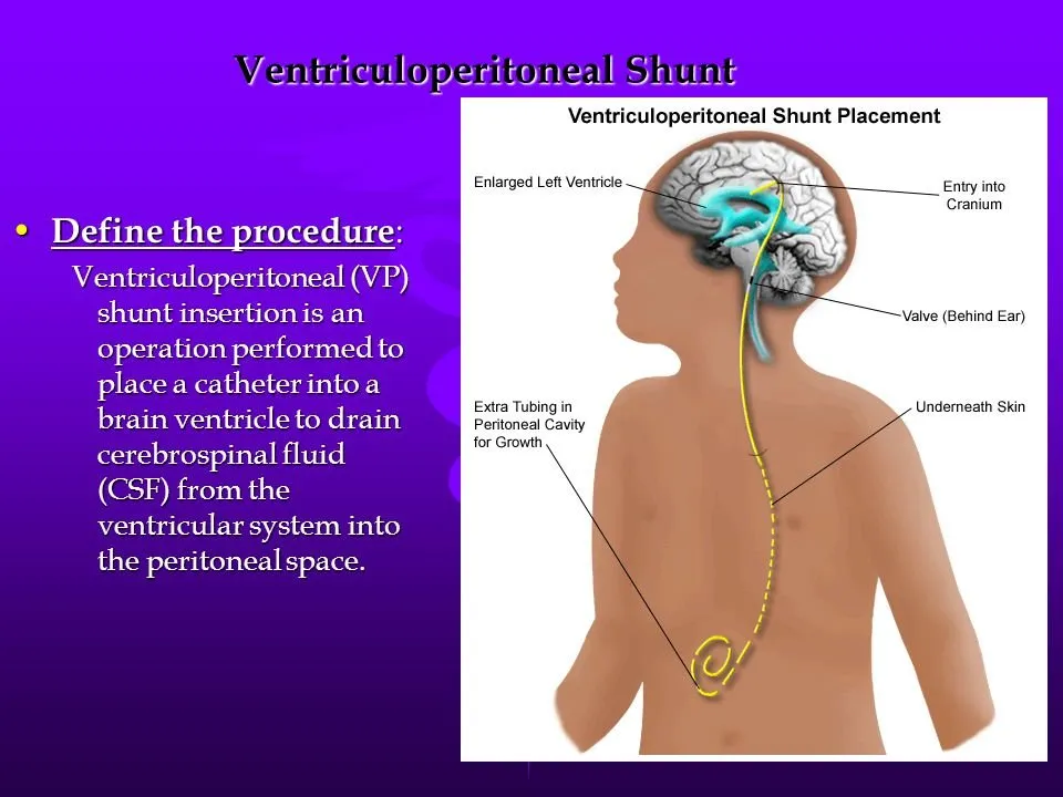 Ventriculoperitoneal+Shunt.jpg