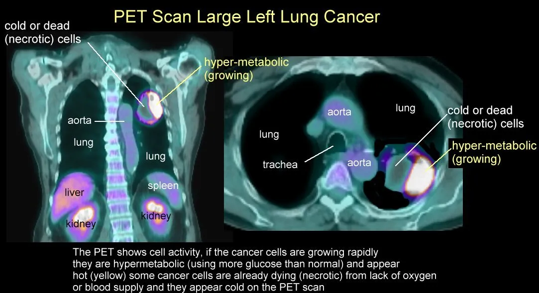 lung_pet_necrotic_1007.jpg