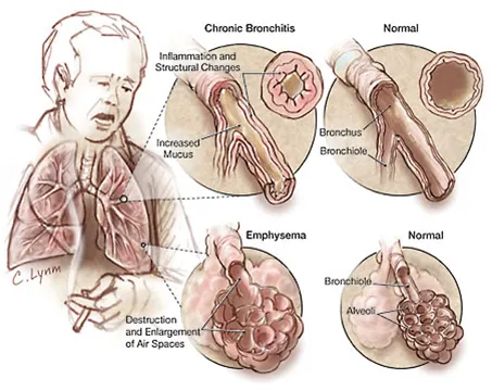 copd.png