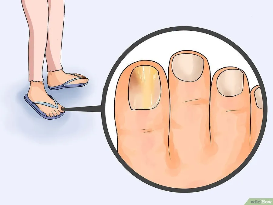 v4-900px-Get-Rid-of-Toe-Fungus-Step-1-Version-2.jpg