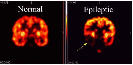 epilepsy.jpg