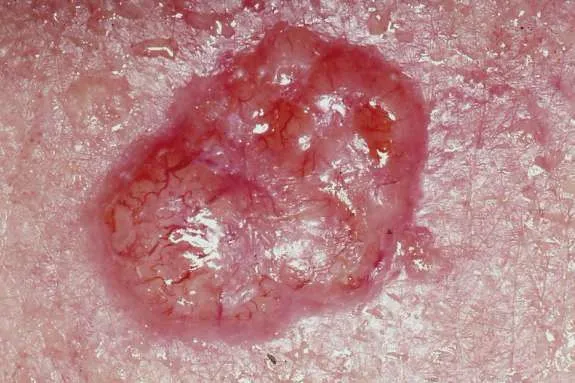 Basal_cell_carcinoma.jpg