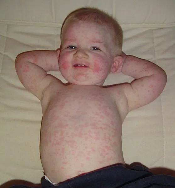 557px-Fifth_disease.jpg