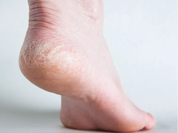 Causes and heel fissures