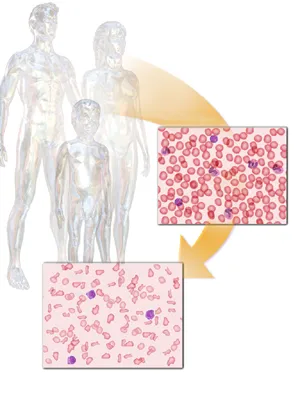 Thalassemia