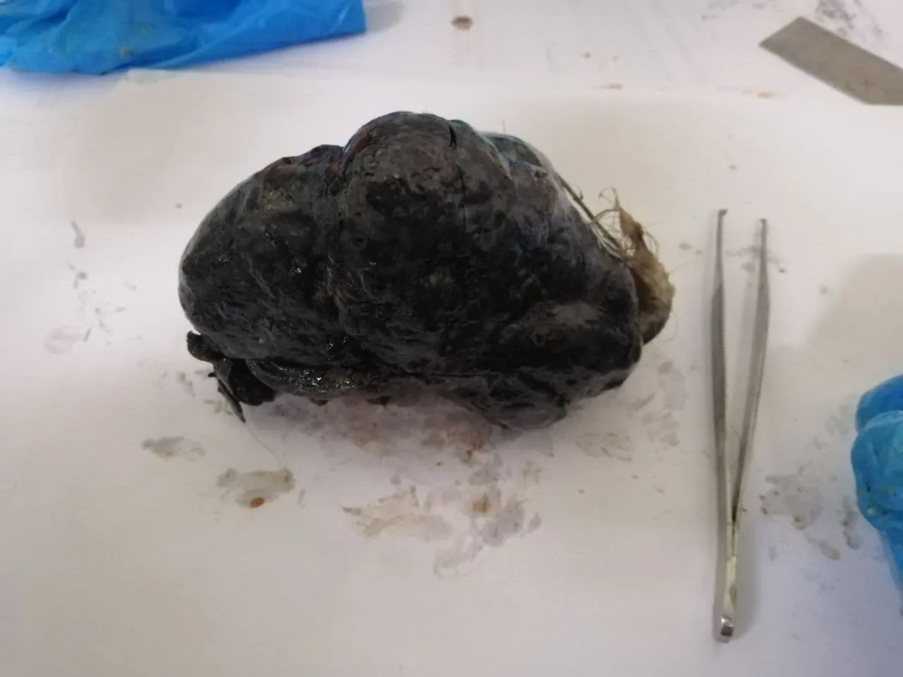 Mature Infarcted Teratoma Uncut.jpg