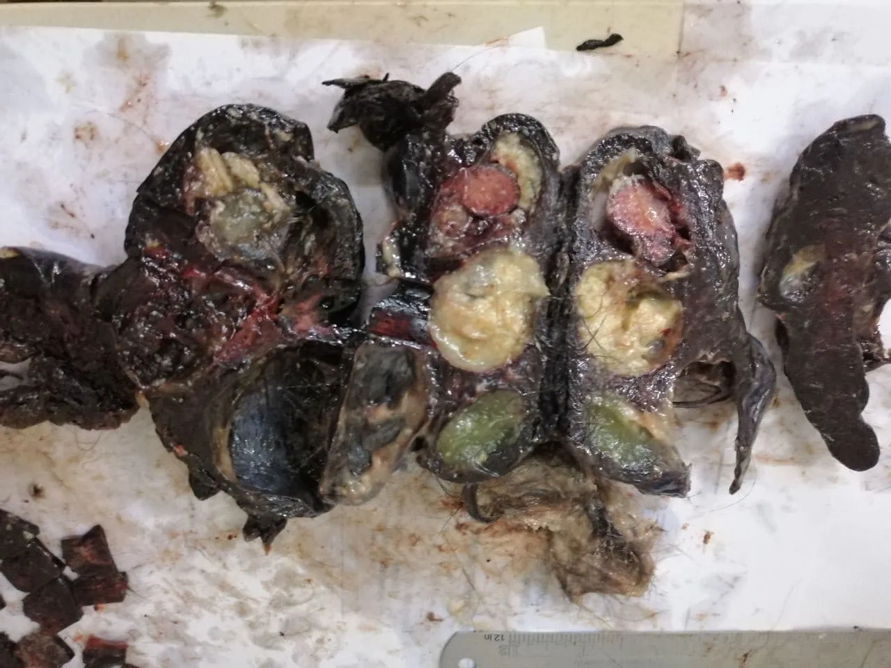 Mature Infarcted Teratoma.jpg