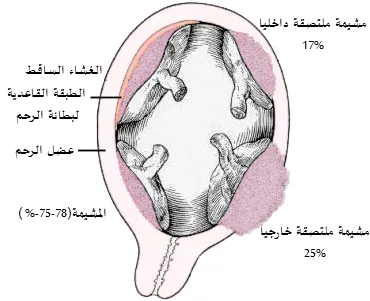 Placenta_accreta-ar.png