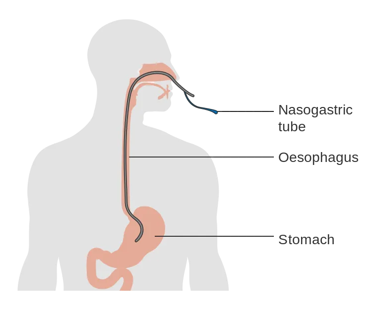 Diagram_showing_the_position_of_a_nasogastric_tube_CRUK_340.svg.png