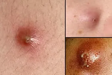 webmd_rm_photo_of_collage_of_boil_symptoms.jpg