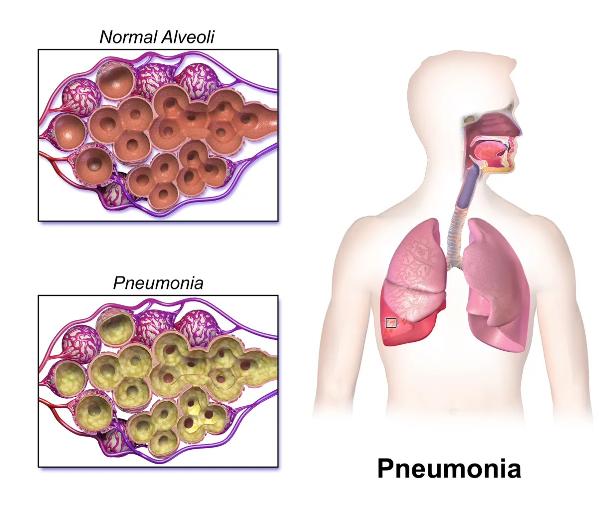 https://commons.wikimedia.org/wiki/File:Blausen_0994_Pneumonia