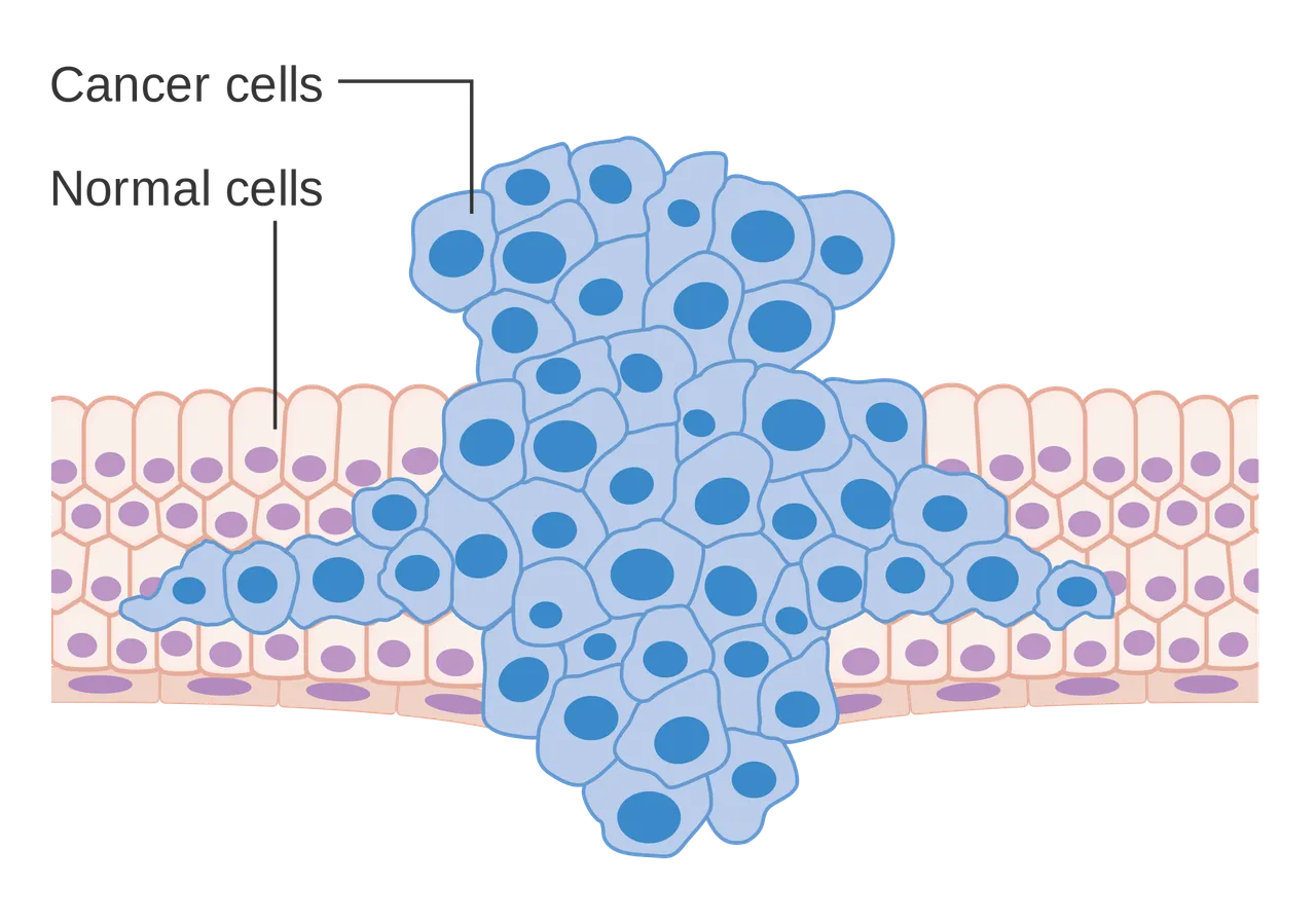 Formation of a tumor forcing its way into the adjacent tissues
