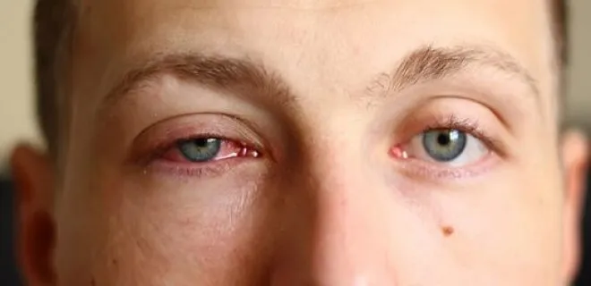 Conjunctivitis