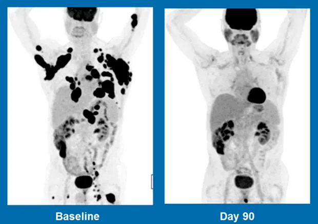 CAR-T-cell-therapy.jpg