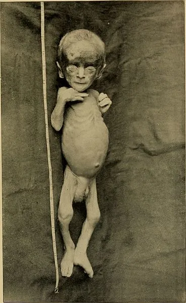 An_American_text-book_of_the_diseases_of_children_(1895)_(14782046202).jpg