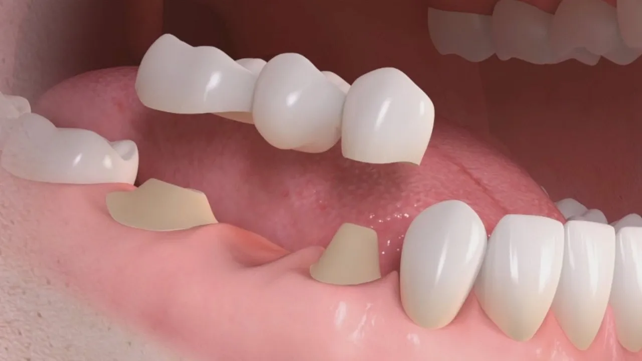 puente-dental-protesis-fija.jpg