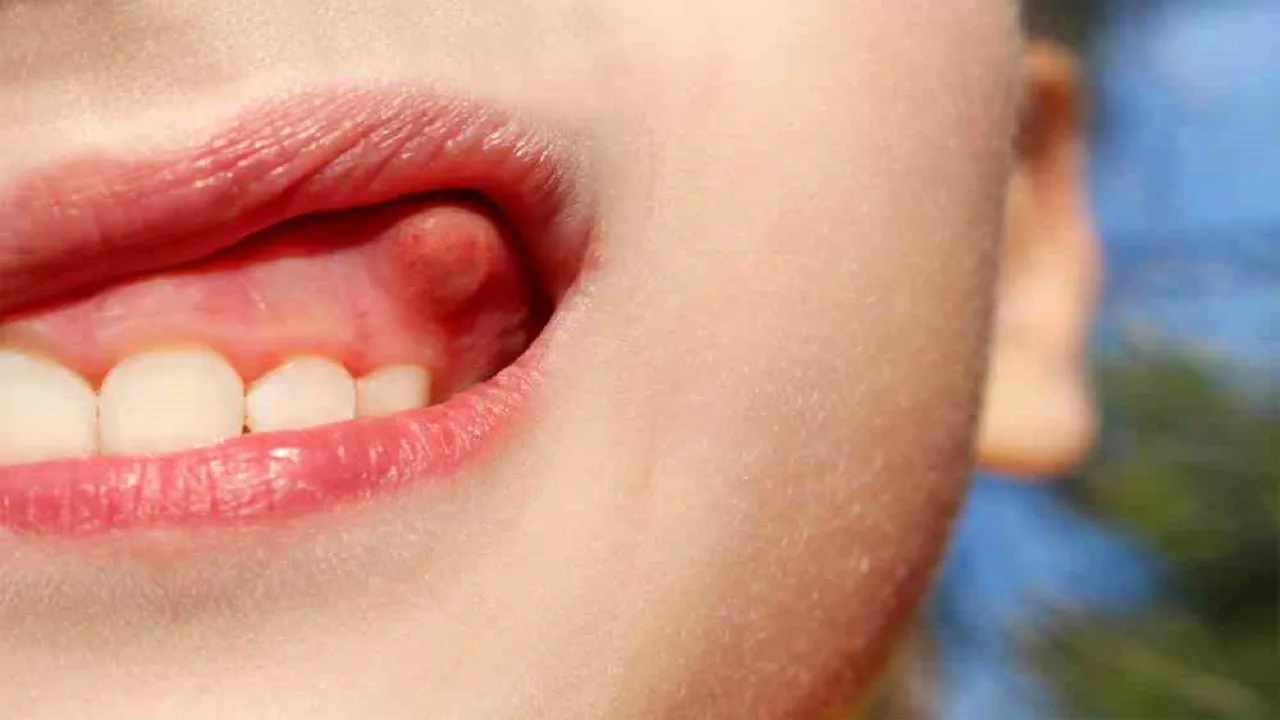 fistula-dental.jpg