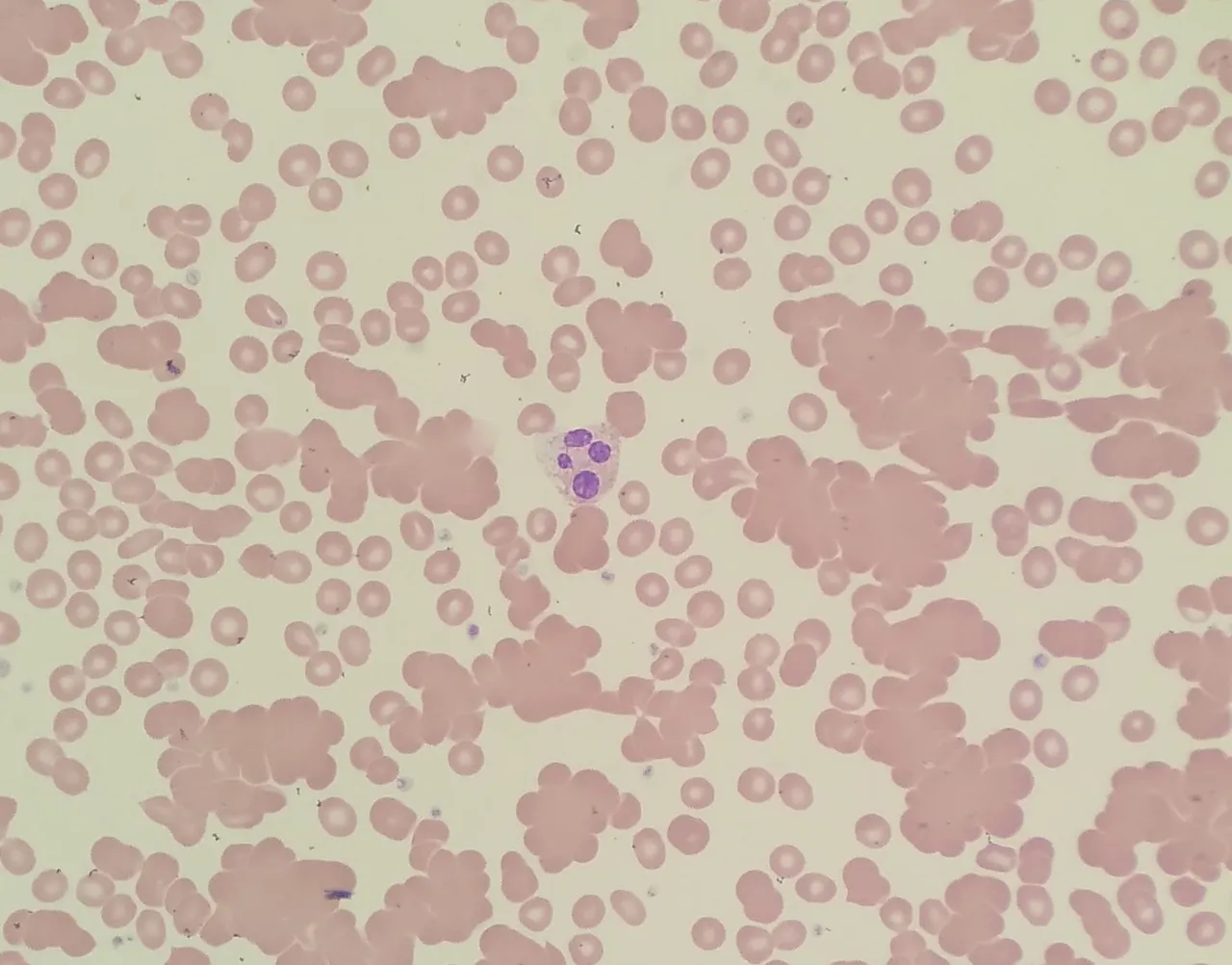 Red_blood_cell_agglutination_due_to_cold_agglutinin.jpg