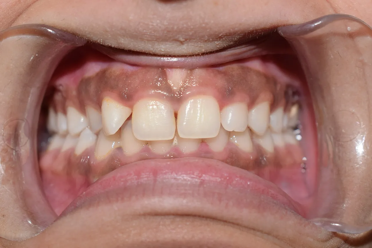 Hyperpigmentation_of_the_gum.jpg