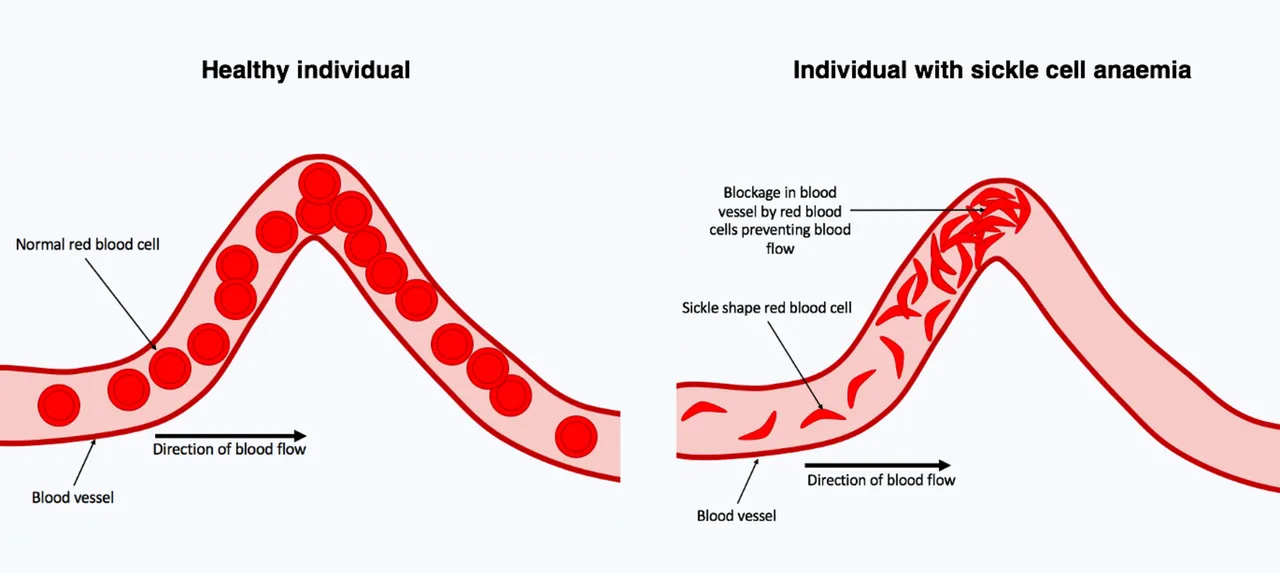 Sickle_Cell_Anaemia_red_blood_cells_in_blood_vessels.png