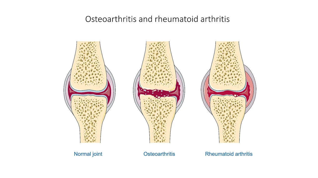 Osteoarthritis_and_rheumatoid_arthritis_-_Normal_joint_Osteoarthr_--_Smart-Servier.jpg