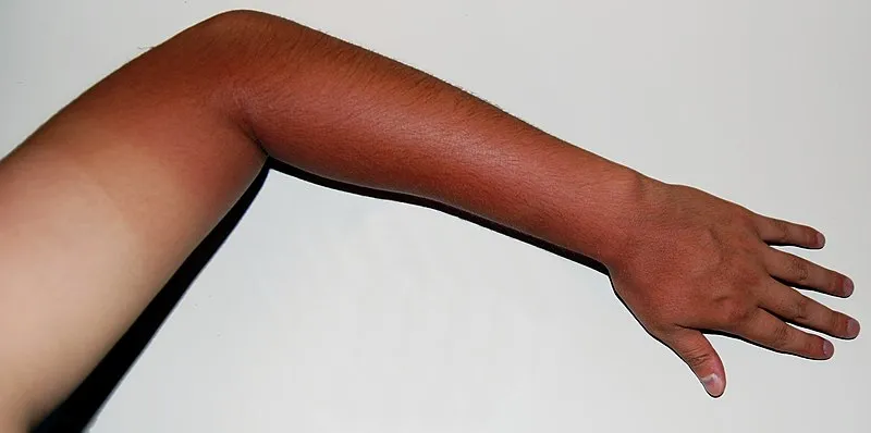 Skin_tanning.JPG