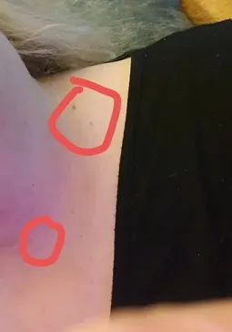 Skin Tag.jpg