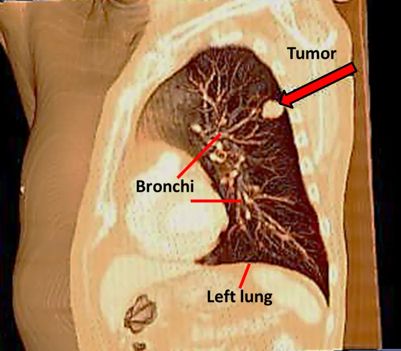 800px-Tumor_in_L._lung-3D_CT_volume_rendering.png