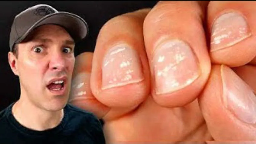 Why do my nails look like this?