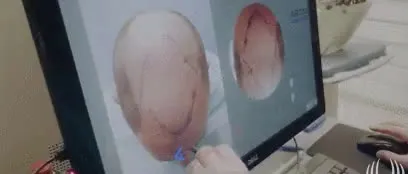 ARTAS-Robotic-Hair-Transplant-System.mp4