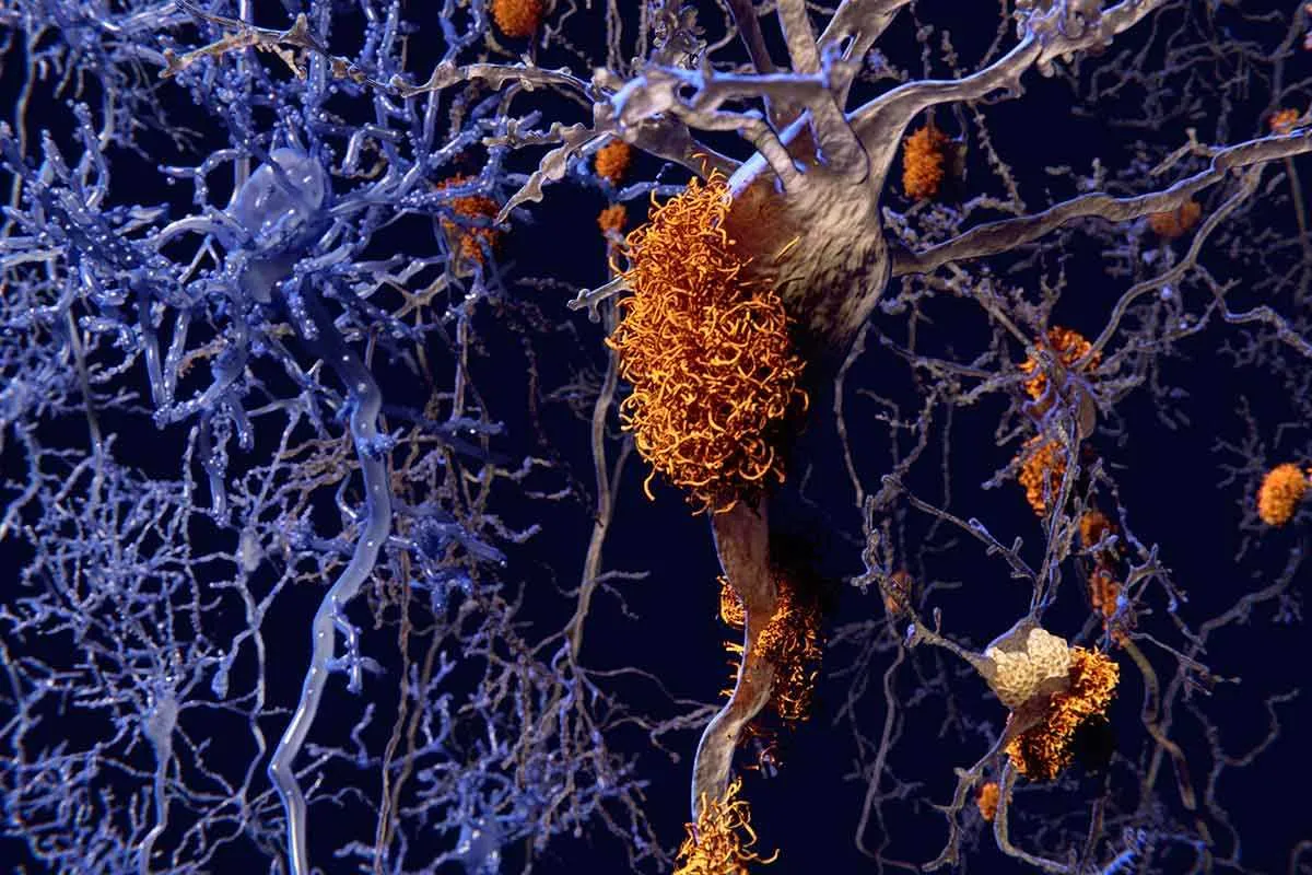 f0117797-brain_nerve_cells_affected_by_alzheimers-spl_1.jpg