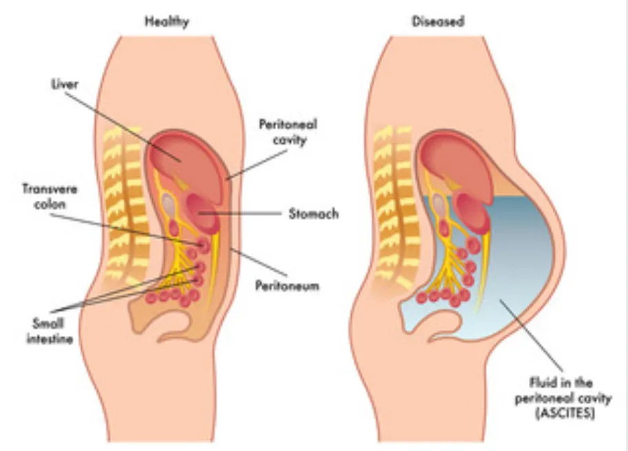 peritoneal.PNG