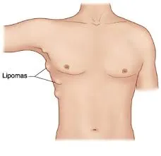 lipoma_illness.jpg