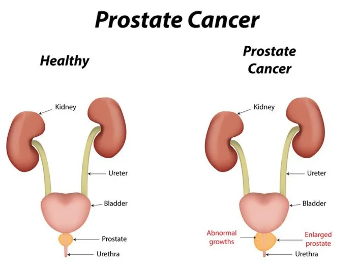 prostatecancer.jpg
