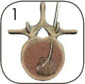 spinaltumor_01.png