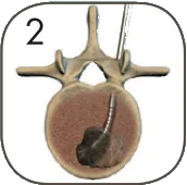 spinaltumor_02.png