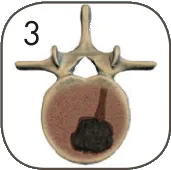 spinaltumor_03.png