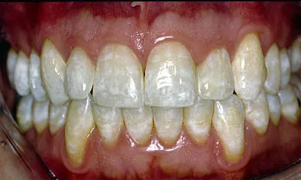 Mild-Fluorosis.jpg