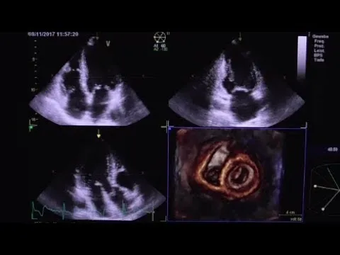 3D Echocardiography.jpg