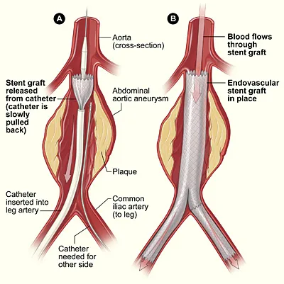 Aneurysm_endovascular.jpg