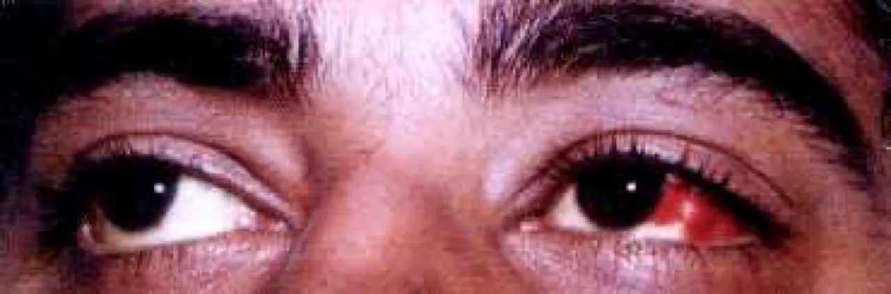 conjunctival hemorrhage.png