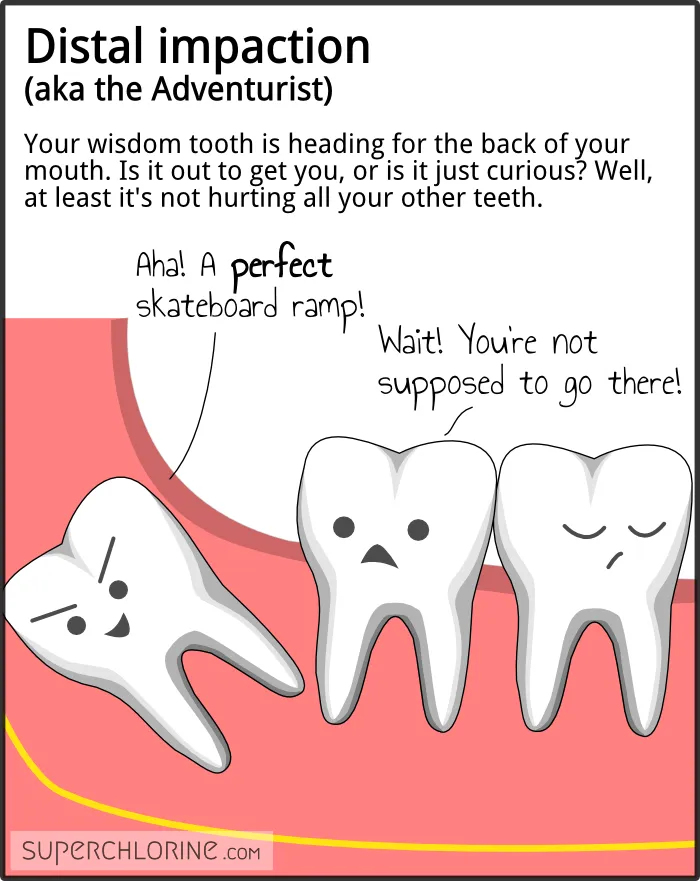 wisdom-teeth-types_distal.png