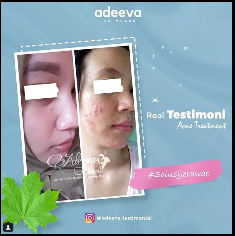 Testimoni Adeeva Acne Series terbaru