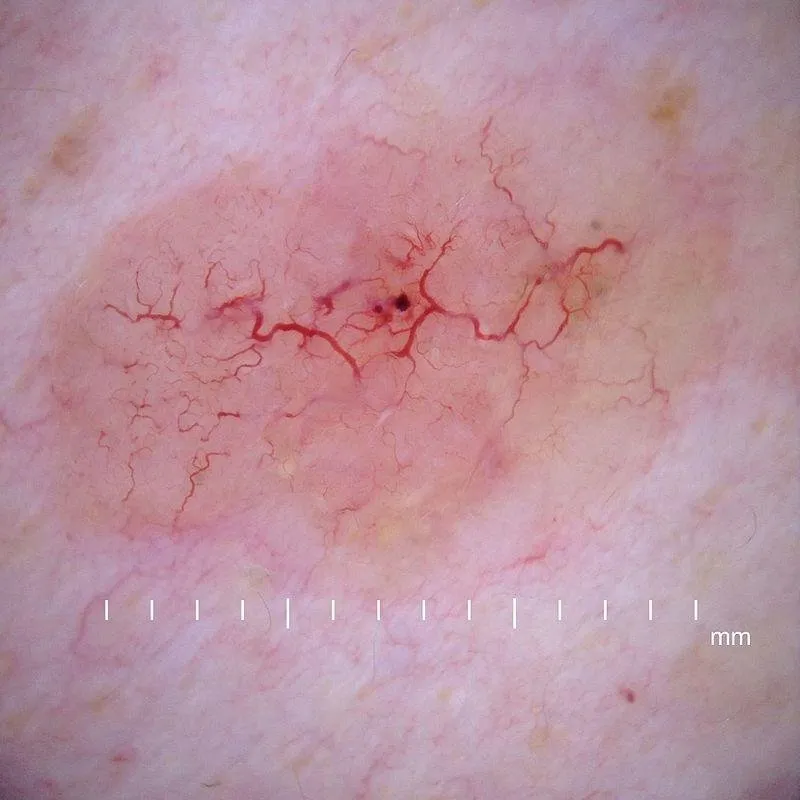 Dermoscopy_nodular_basal_cell_carcinoma.jpg