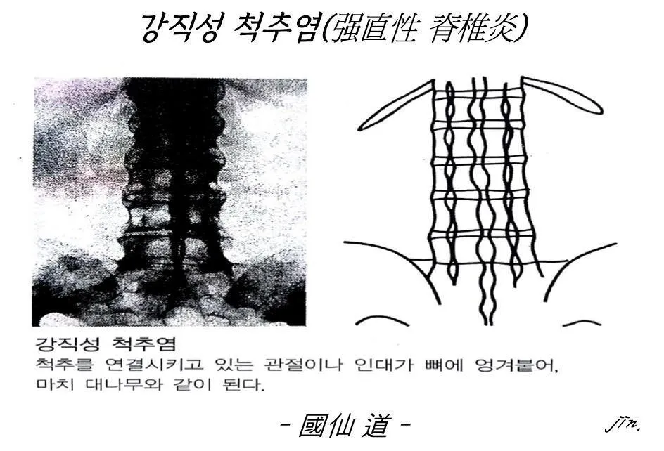 강직성 척추염-1.jpg