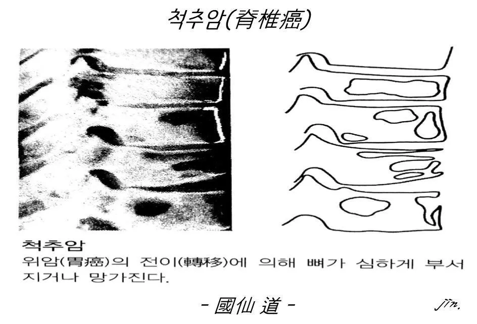 척추암-1.jpg