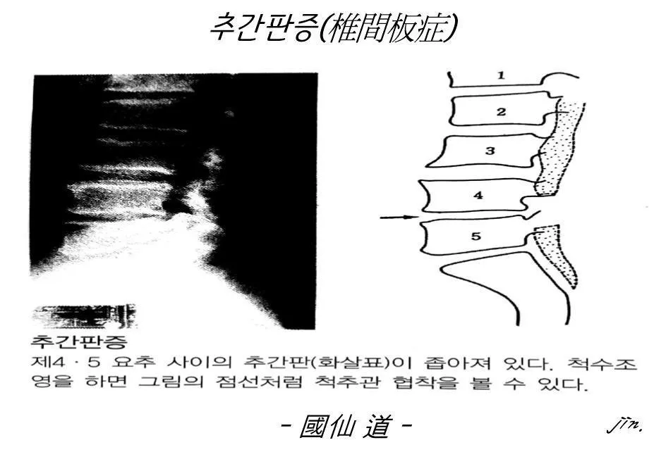 추간판증1.jpg