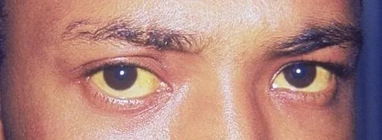Jaundice_eye.jpg